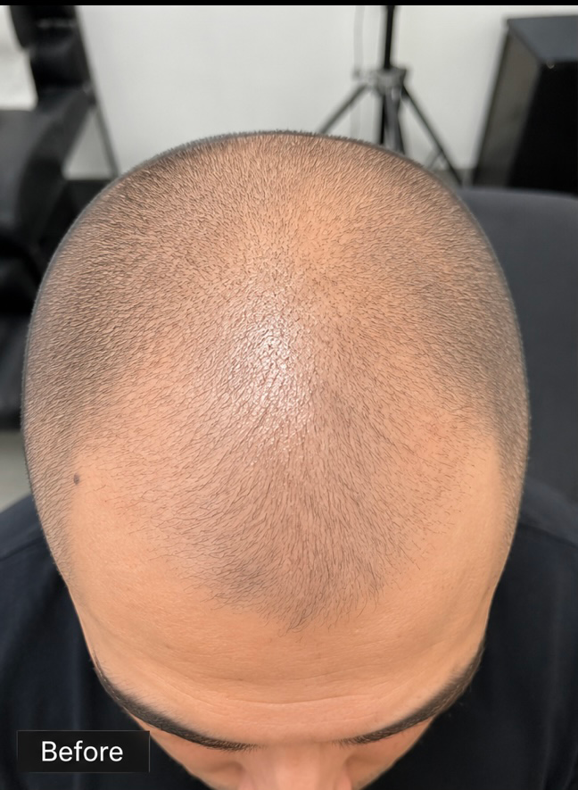 Before Microscalp